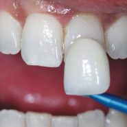 Lente de Contato Dental em Cornélio Procópio