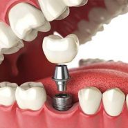 Implantes Dentários (Implantodontia) em Cornélio Procópio