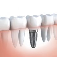 Implantes Dentários (Implantodontia) em Cornélio Procópio 2