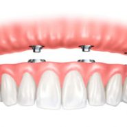 Implantes Dentários (Implantodontia) em Cornélio Procópio 3