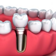 Implantes Dentários (Implantodontia) em Cornélio Procópio 4