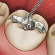 Restaurações Dentárias Diretas ou Indiretas em Cornélio Procópio 3