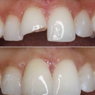 Restaurações Dentárias Diretas ou Indiretas