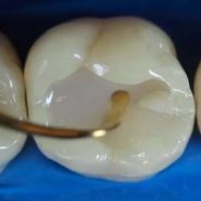 Restaurações Dentárias Diretas ou Indiretas em Cornélio Procópio 4