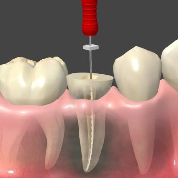 Tratamento de Canal (Endodontia)