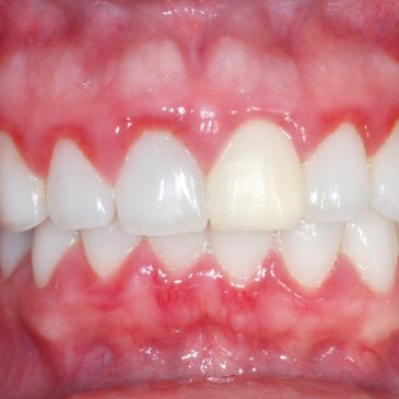 Tratamento para Gengivite e Periodontite (Periodontia)