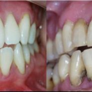 Tratamento para Gengivite e Periodontite em Cornélio Procópio 4